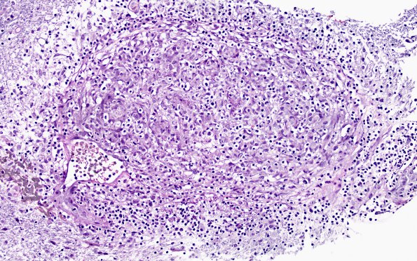 3B3A Angiitis, granulomatous, CNS only (Case 3) EVGNC 2