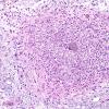 3B3B Angiitis, granulomatous, CNS only (Case 3) EVGNC 5