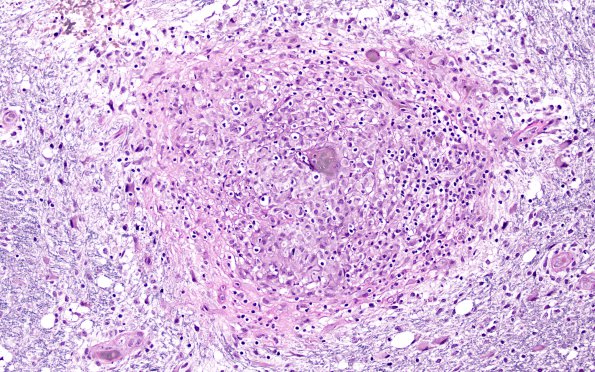 3B3B Angiitis, granulomatous, CNS only (Case 3) EVGNC 5