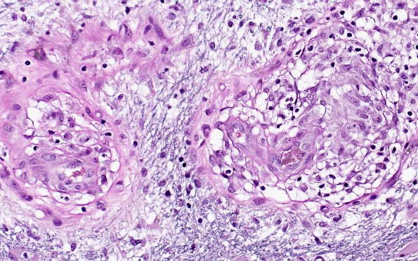 3B3C Angiitis, granulomatous, CNS only (Case 3) EVGNC 1