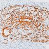 3B4A Angiitis, granulomatous, CNS only (Case 3) SMA 1