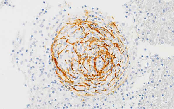 3B4B Angiitis, granulomatous, CNS only (Case 3) SMA 4