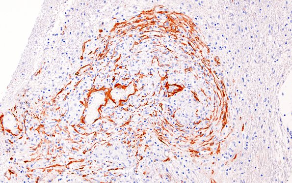 3B4C Angiitis, granulomatous, CNS only (Case 3) SMA 11