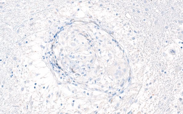 3B8 Angiitis, granulomatous, CNS only (Case 3) Bamyloid 1