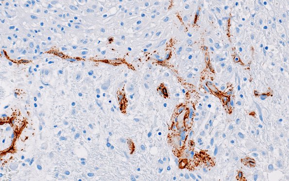 3B9 Angiitis, granulomatous, CNS only (Case 3) CD34 12