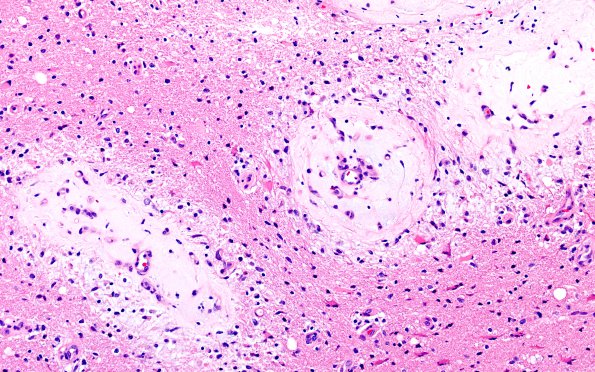 3C1 Angiitis, granulomatous, CNS only (Case 3) H&E 6