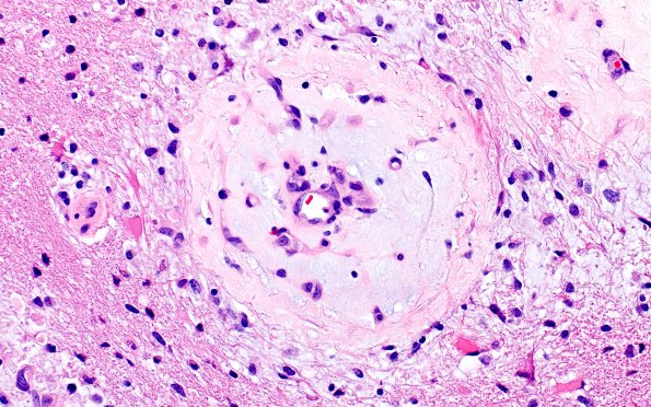 3C2 Angiitis, granulomatous, CNS only (Case 3) H&E 5