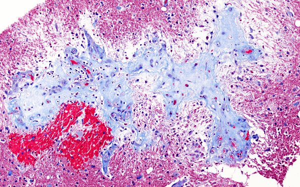 3C3  Angiitis, granulomatous, CNS only (Case 3) Trichrome 2