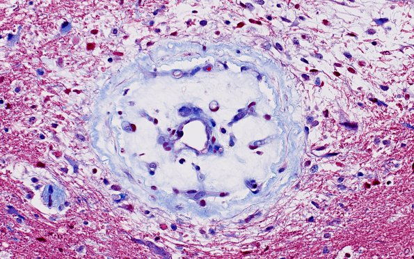 3C4  Angiitis, granulomatous, CNS only (Case 3) Trichrome 3