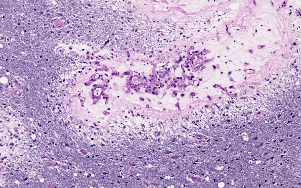 3C5 Angiitis, granulomatous, CNS only (Case 3) EVGNC 4