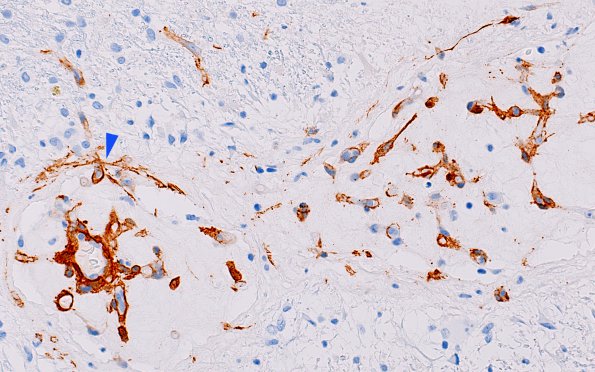 3C6 Angiitis, granulomatous, CNS only (Case 3) SMA 7 copy