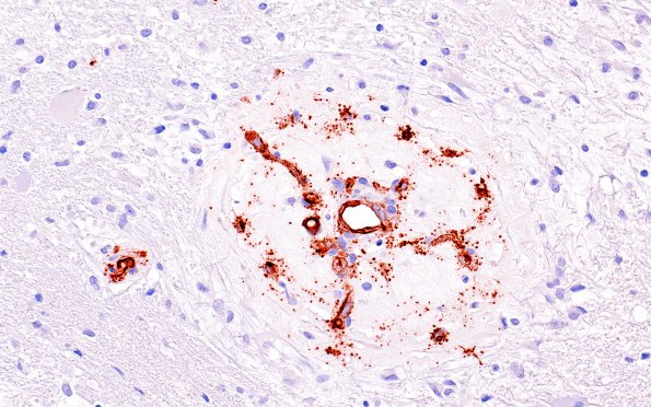 3C8 Angiitis, granulomatous, CNS only (Case 3) CD34 5