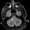 4A1 Angiitis, granulomatous (Case 4) TIRM - Copy