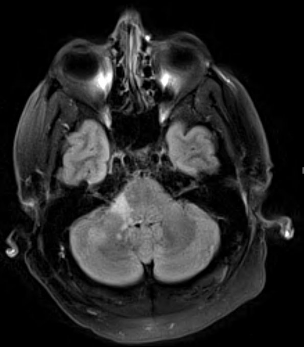 4A1 Angiitis, granulomatous (Case 4) TIRM - Copy