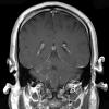 4A2 Angiitis, granulomatous (Case 4) T1 W 2 - Copy