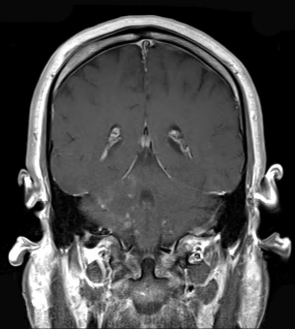 4A2 Angiitis, granulomatous (Case 4) T1 W 2 - Copy