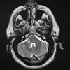 4A3 Angiitis, granulomatous (Case 4) T2 2 - Copy