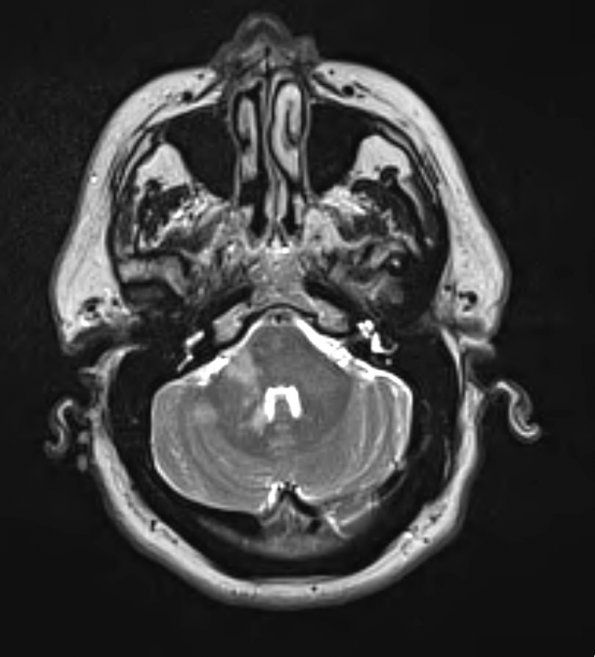 4A3 Angiitis, granulomatous (Case 4) T2 2 - Copy