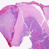 4B1 Angiitis, granulomatous (Case 4) H&E 4X