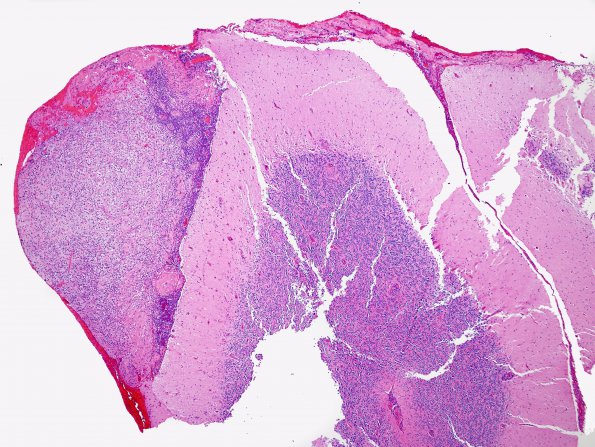 4B1 Angiitis, granulomatous (Case 4) H&E 4X