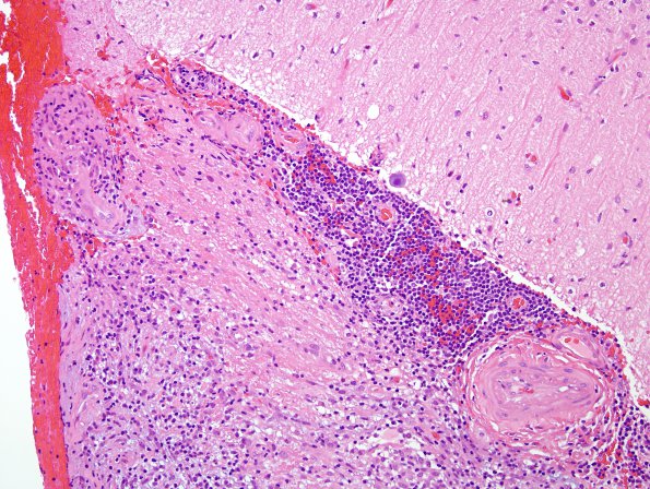 4B2 Angiitis, granulomatous (Case 4) H&E 11