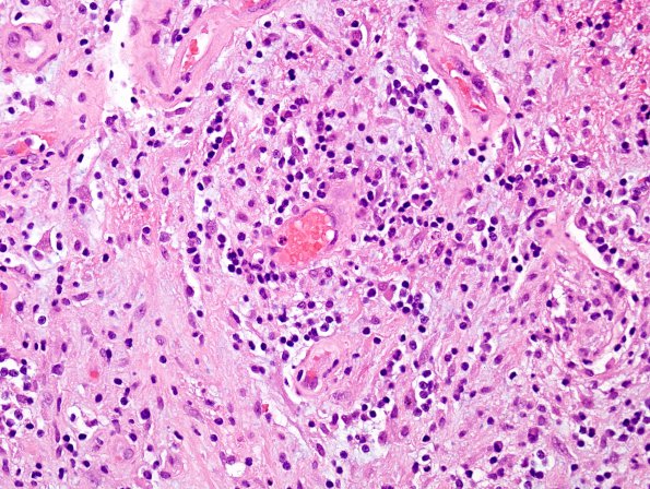 4B3 Angiitis, granulomatous (Case 4) H&E 2