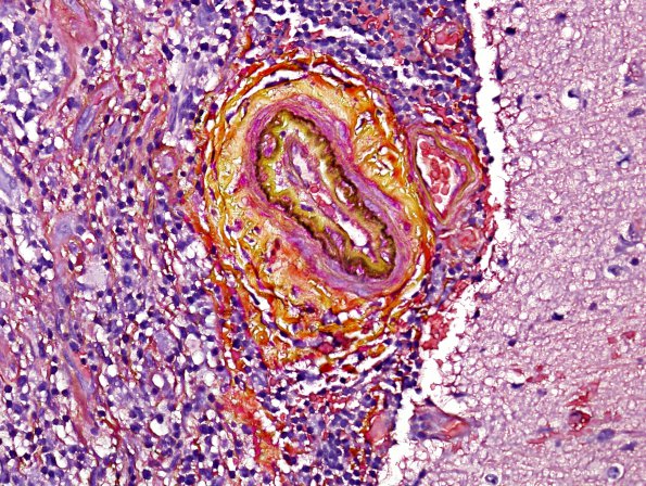 4C2 Angiitis, granulomatous (Case 4) Pentachrome 2