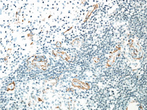 4D1 Angiitis, granulomatous (Case 4) SMA 2