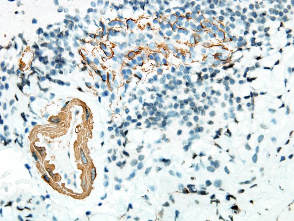 4D2 Angiitis, granulomatous (Case 4) SMA 7