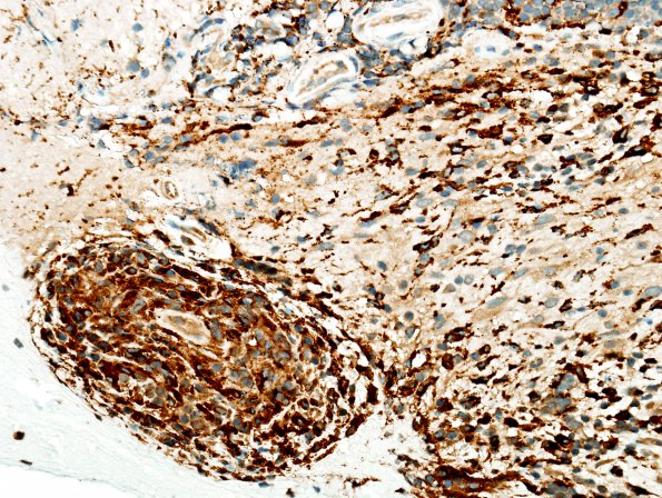 4E3 Angiitis, granulomatous (Case 4) CD68 5