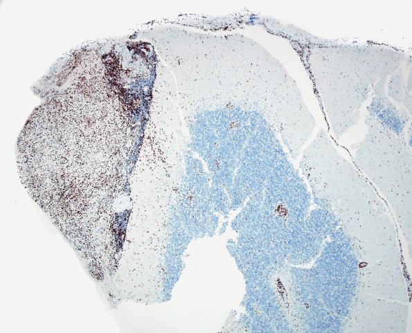 4F1 Angiitis, granulomatous (Case 4) CD3 4X