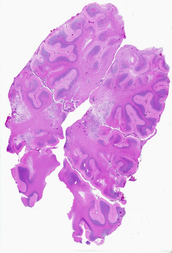 5A1A Vasculitis, granulomatous (Case 5) H&E a