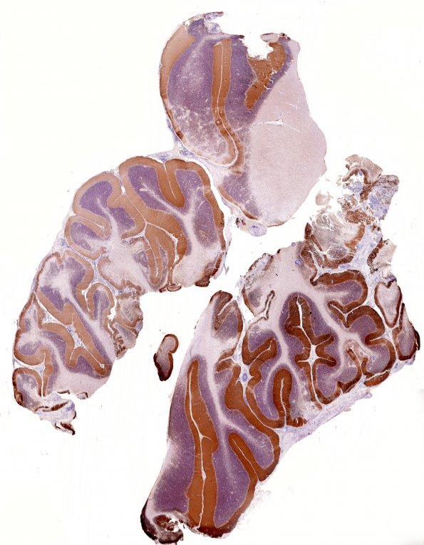 5A1B Vasculitis, granulomatous (Case 5)  SYN b