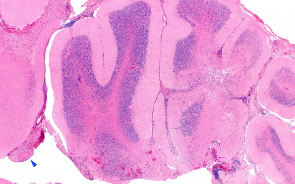 5A2 Vasculitis (Case 5) H&E B 2X copy