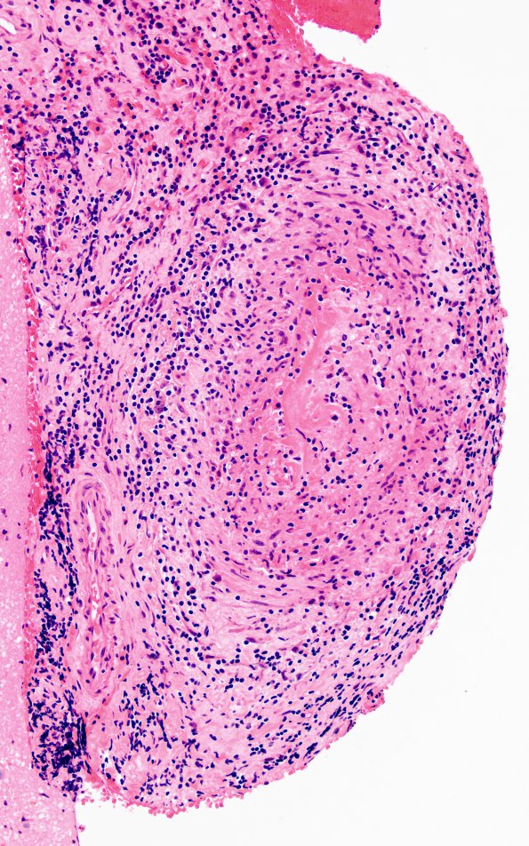 5A3 Vasculitis (Case 5) H&E B 20X