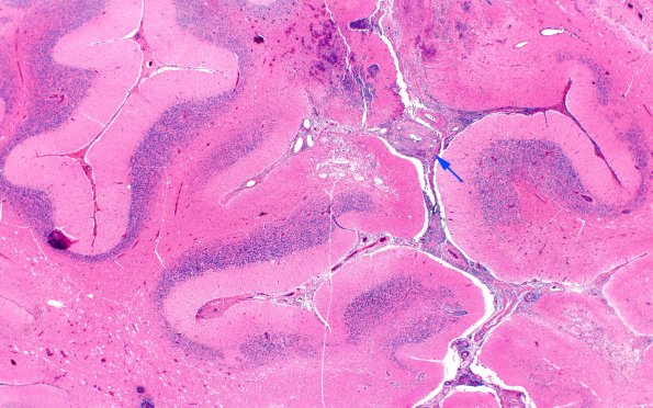 5A4 Vasculitis (Case 5) H&E A2X copy