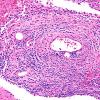 5A5 Vasculitis (Case 5) H&E A 20X