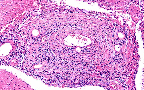 5A5 Vasculitis (Case 5) H&E A 20X