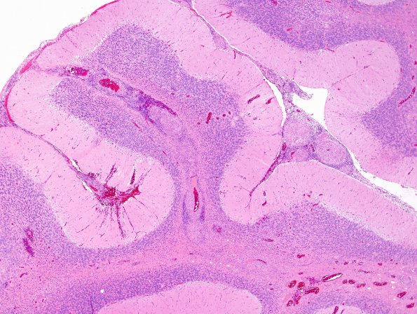 6A1 Angiitis, granulomatous (vs Sarcoid, Case 6) H&E 9