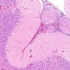 6A2 Angiitis, granulomatous (vs Sarcoid, Case 6) H&E 11