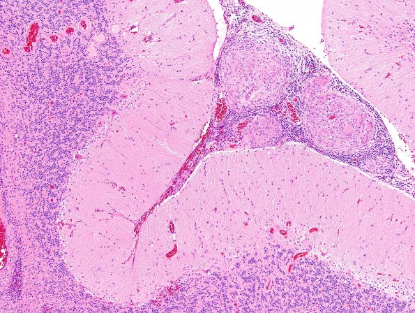 6A2 Angiitis, granulomatous (vs Sarcoid, Case 6) H&E 11