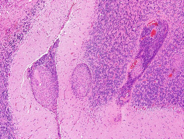 6A3 Angiitis, granulomatous (vs Sarcoid, Case 6) H&E 6