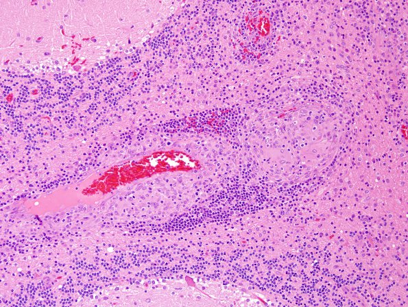 6A4 Angiitis, granulomatous (vs Sarcoid, Case 6) H&E 12