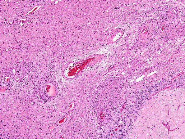 6A5 Angiitis, granulomatous (vs Sarcoid, Case 6) H&E 4.