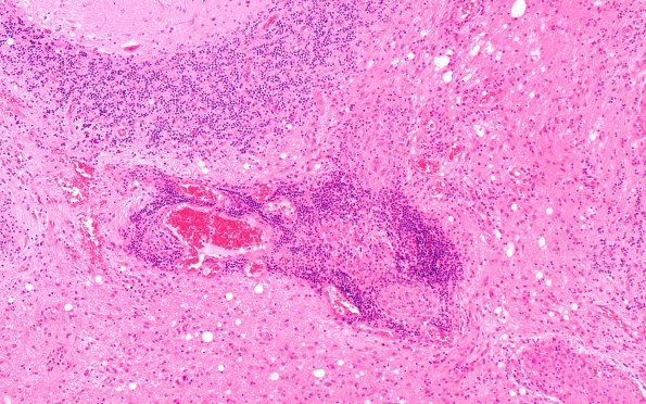 6B1 Angiitis, granulomatous Case 6) A2 H&E 10X match CD34 4X 2