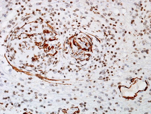 6B3 Angiitis, granulomatous (vs Sarcoid, Case 6) SMA 6