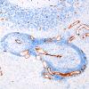 6B4 Angiitis, granulomatous (vs Sarcoid, Case 6) CD34 6