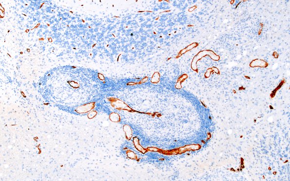 6B4 Angiitis, granulomatous (vs Sarcoid, Case 6) CD34 6