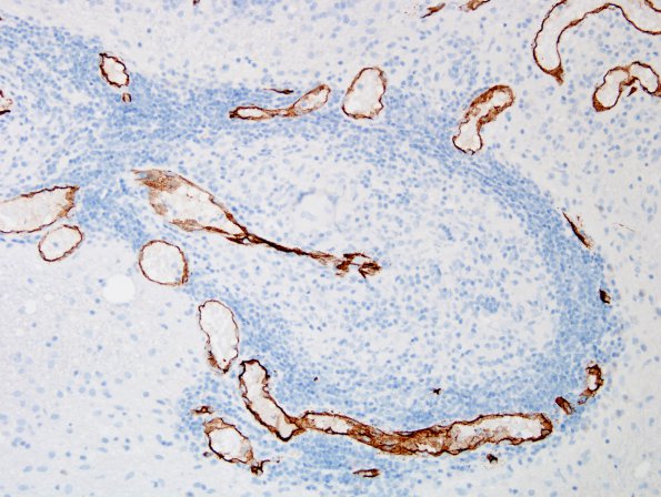 6B5 Angiitis, granulomatous (vs Sarcoid, Case 6) CD34 7