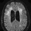 7A1 Granulomatous Angiitis (Case 7) FLAIR 2 - Copy